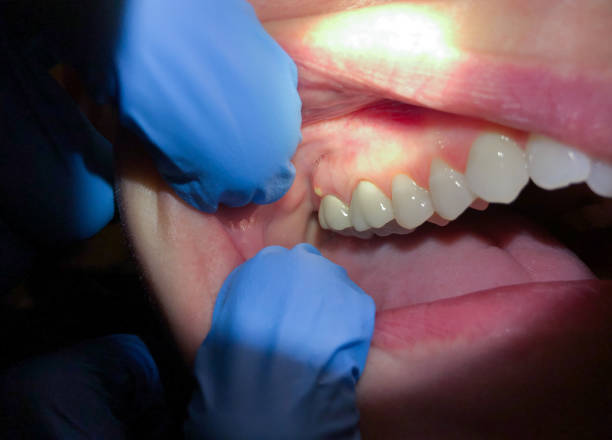 Best Emergency Dental Care for Abscessed Tooth in Newark, NY